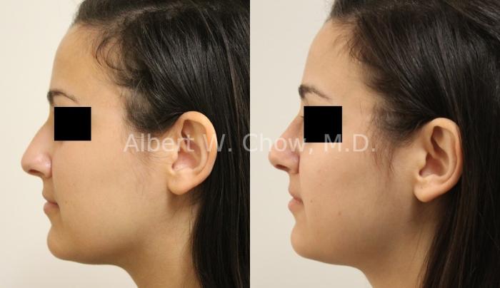 Before & After Rhinoplasty Case 86 View #1 View in San Francisco, CA