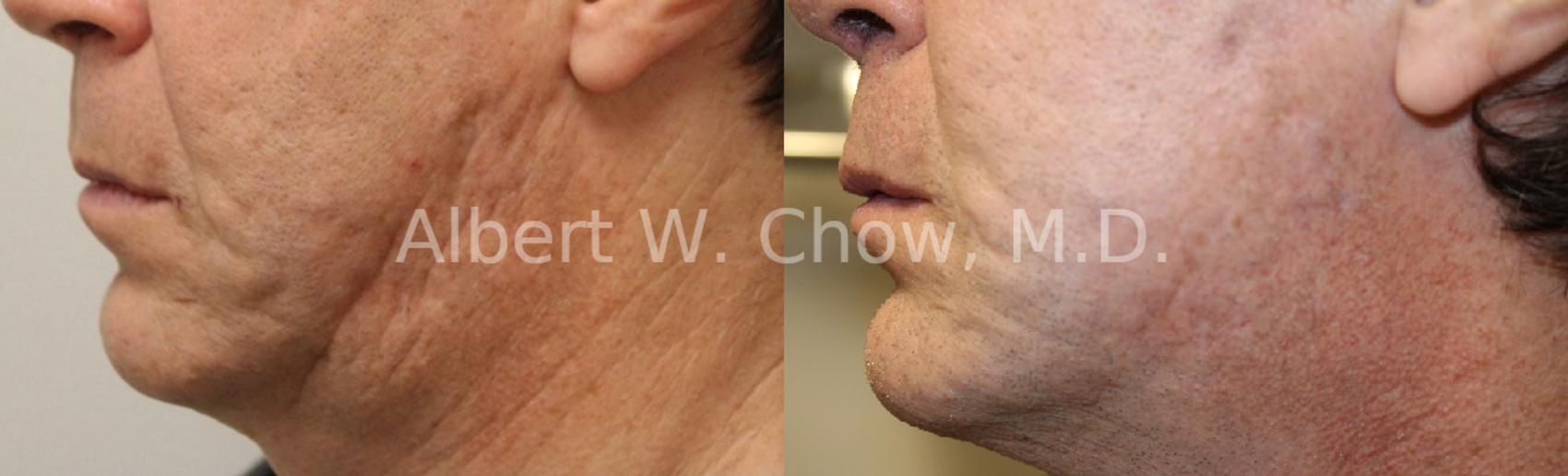 Before & After Acne Scar Treatment Case 56 View #1 View in San Francisco, CA