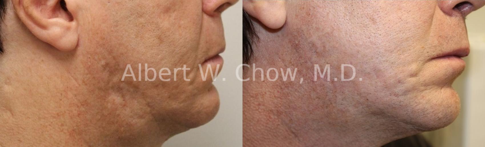 Before & After Acne Scar Treatment Case 57 View #1 View in San Francisco, CA