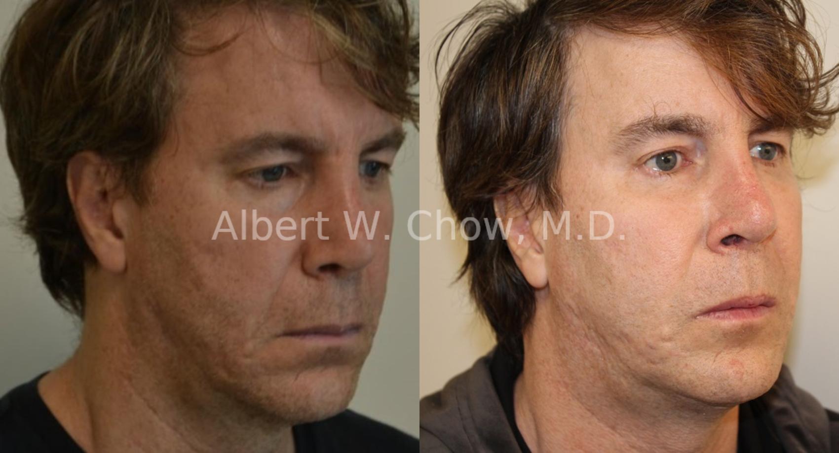 Before & After Acne Scar Treatment Case 58 View #1 View in San Francisco, CA