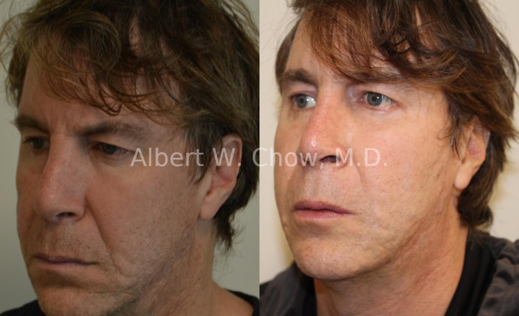 Before & After Acne Scar Treatment Case 59 View #1 View in San Francisco, CA