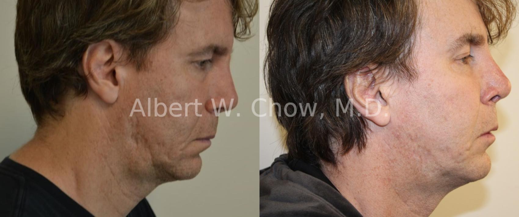 Before & After Acne Scar Treatment Case 60 View #1 View in San Francisco, CA