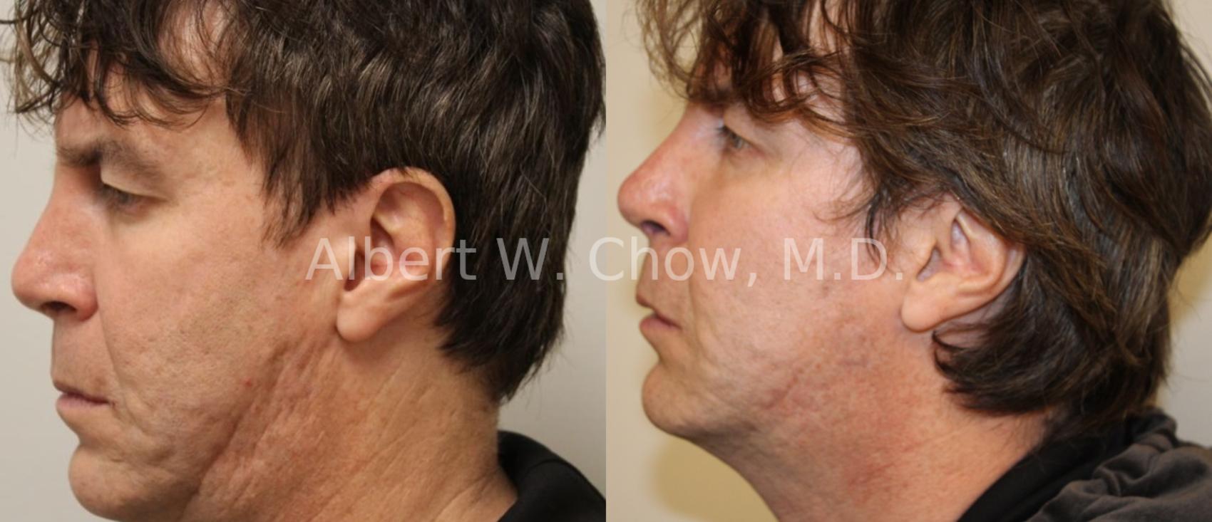 Before & After Acne Scar Treatment Case 61 View #1 View in San Francisco, CA