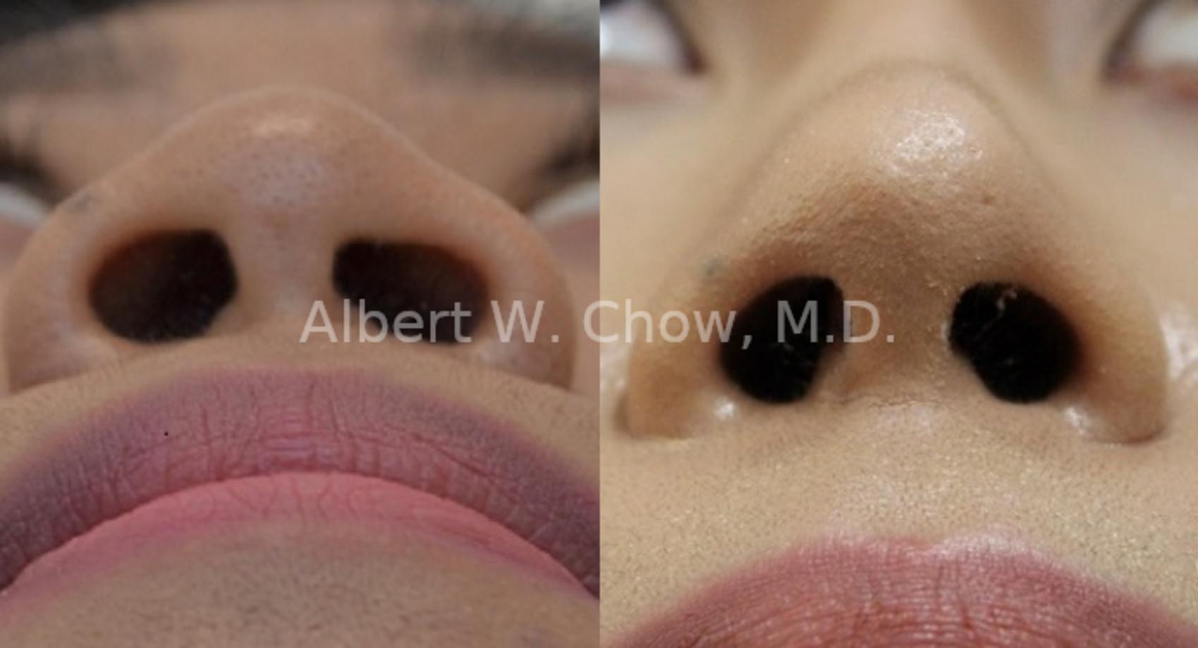 Before & After Asian Rhinoplasty Case 101 View #1 View in San Francisco, CA
