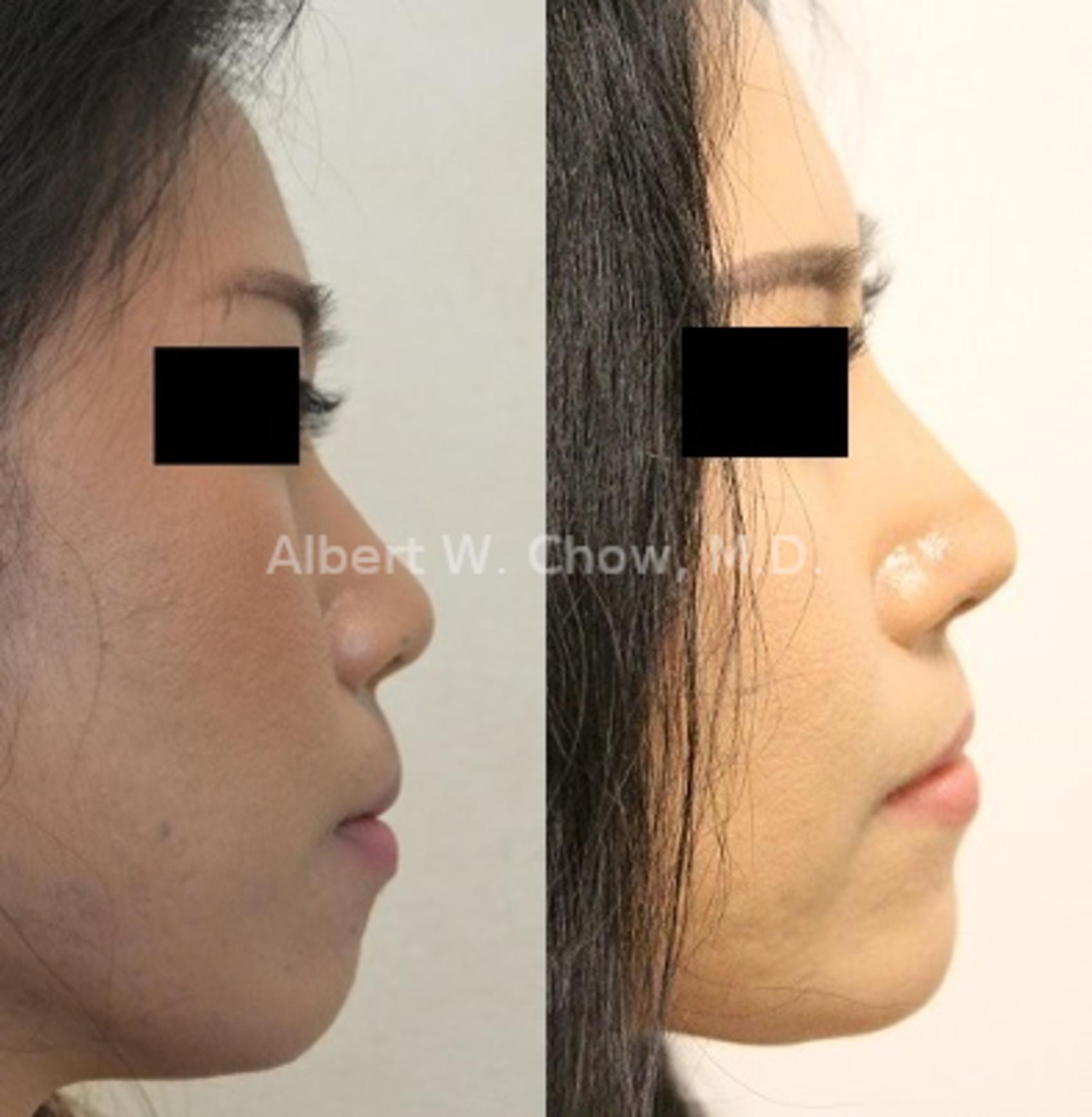 Before & After Rhinoplasty Case 103 View #1 View in San Francisco, CA