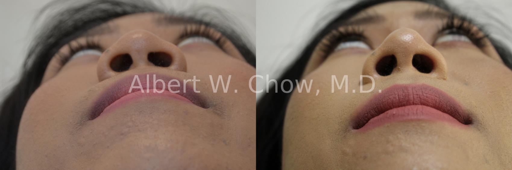 Before & After Asian Rhinoplasty Case 103 View #2 View in San Francisco, CA