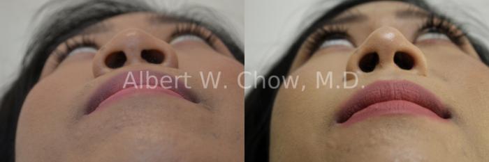 Before & After Rhinoplasty Case 103 View #2 View in San Francisco, CA