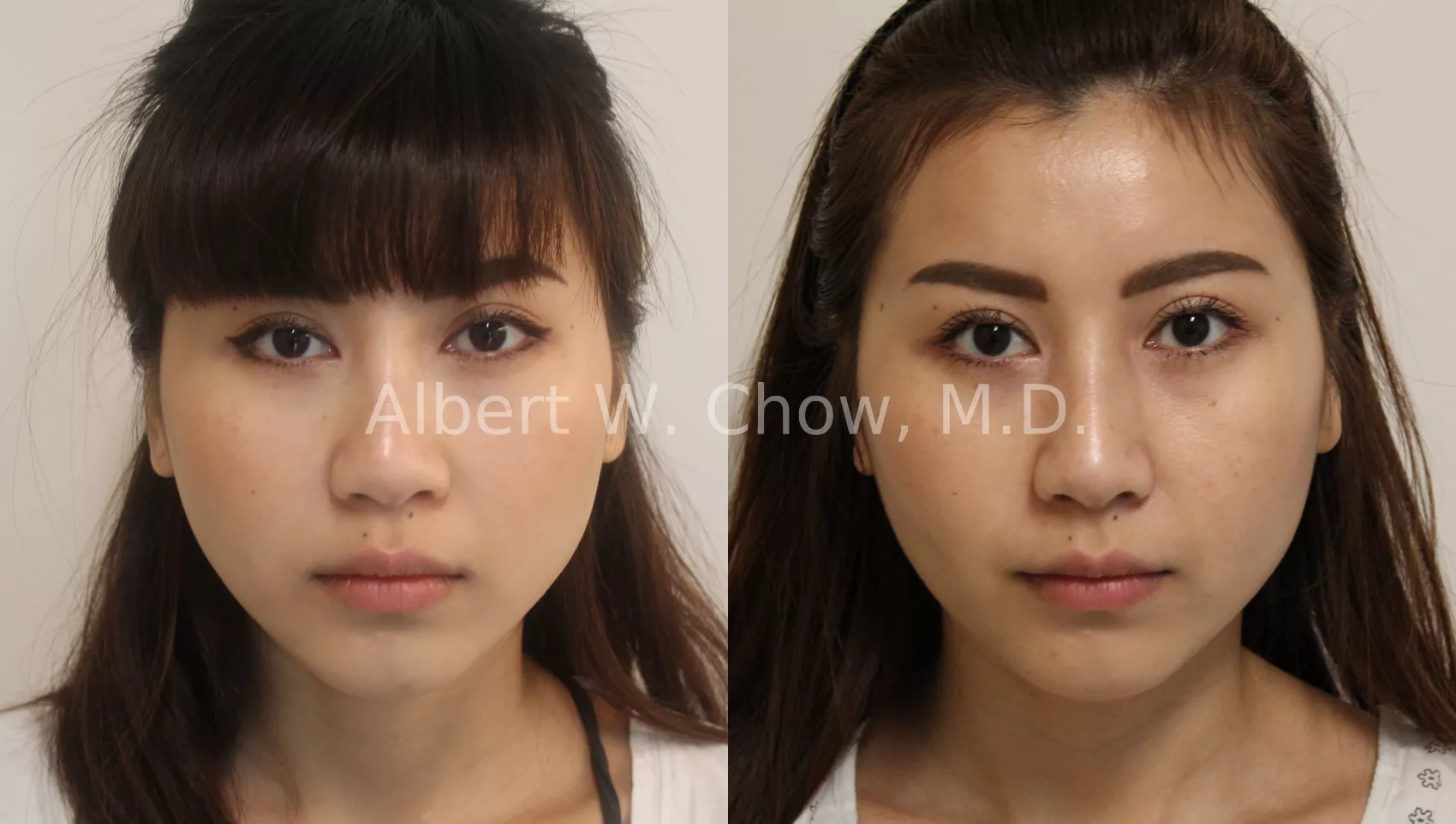 Asian Rhinoplasty Case #120
