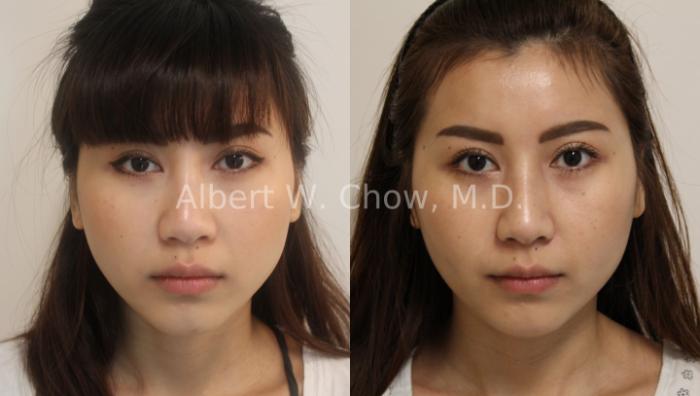 Before & After Rhinoplasty Case 120 View #1 View in San Francisco, CA