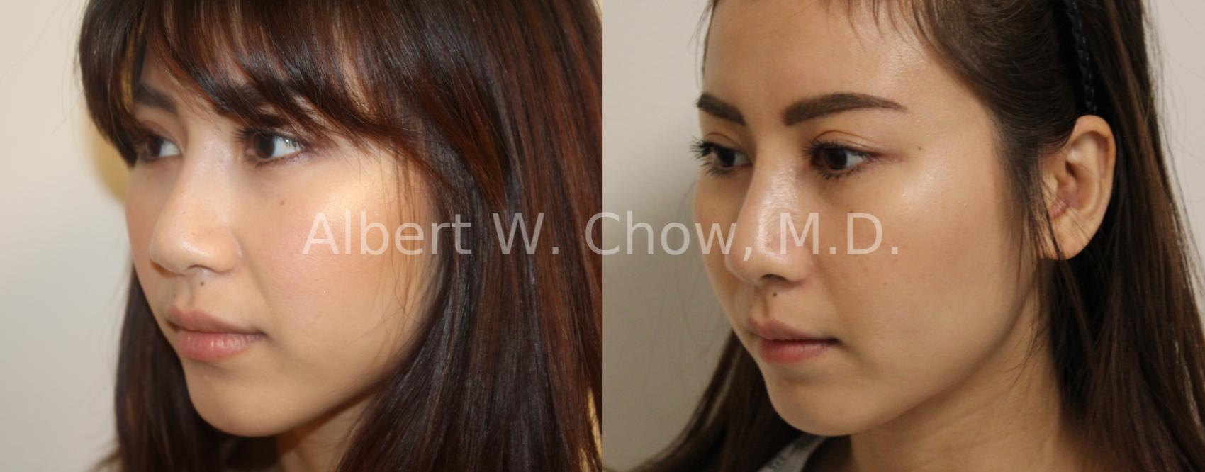 Before & After Rhinoplasty Case 120 View #2 View in San Francisco, CA