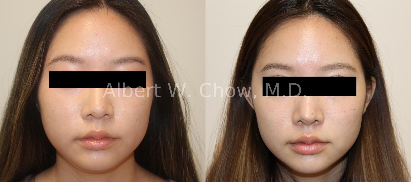 Before & After Asian Rhinoplasty Case 121 Front View in San Francisco, CA