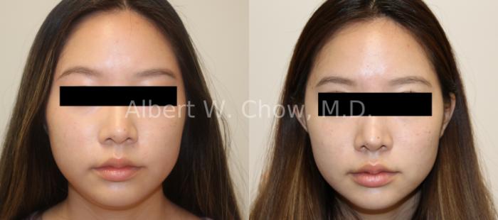 Before & After Rhinoplasty Case 121 Front View in San Francisco, CA