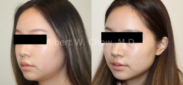 Before & After Rhinoplasty Case 121 Left Oblique View in San Francisco, CA