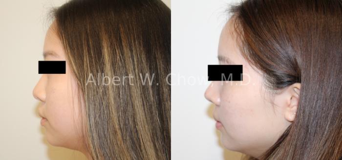 Before & After Rhinoplasty Case 121 Left Side View in San Francisco, CA