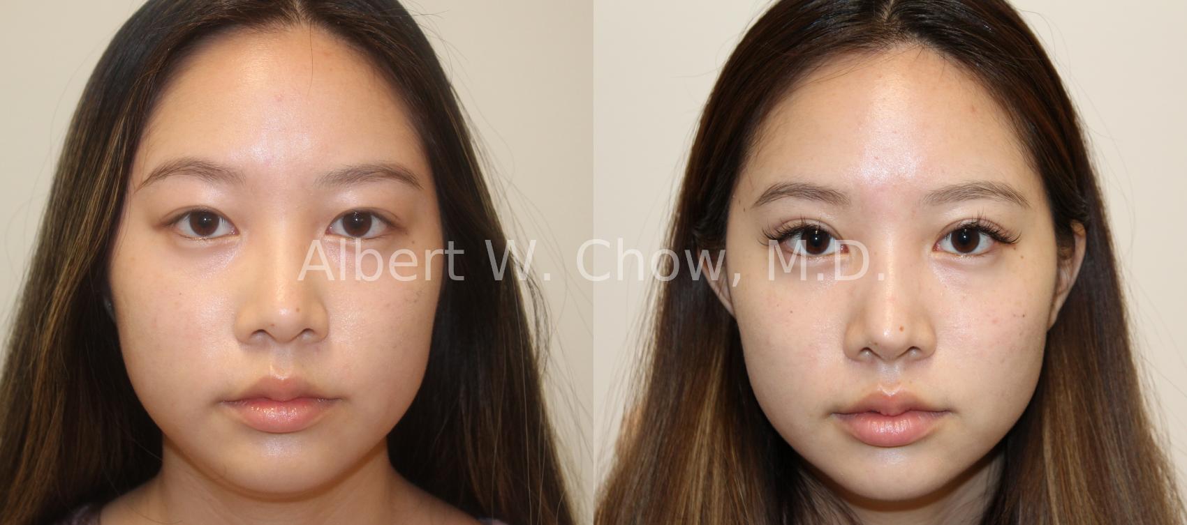 Before & After Asian Rhinoplasty Case 121 View #1 View in San Francisco, CA