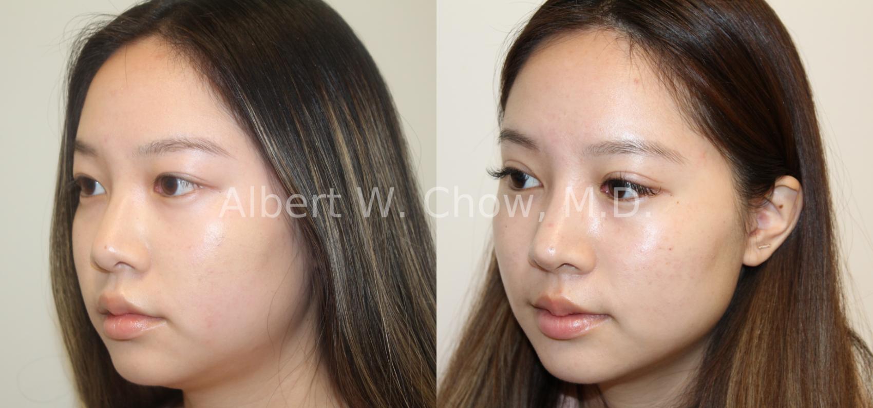 Before & After Asian Rhinoplasty Case 121 View #2 View in San Francisco, CA