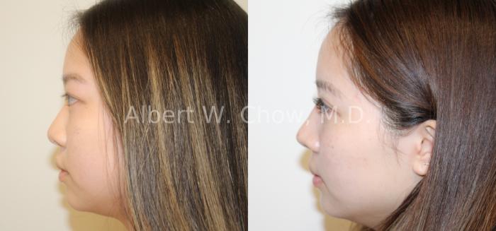Before & After Rhinoplasty Case 121 View #3 View in San Francisco, CA