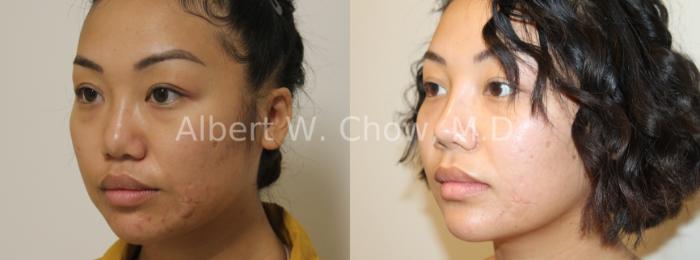 Before & After Rhinoplasty Case 122 View #1 View in San Francisco, CA
