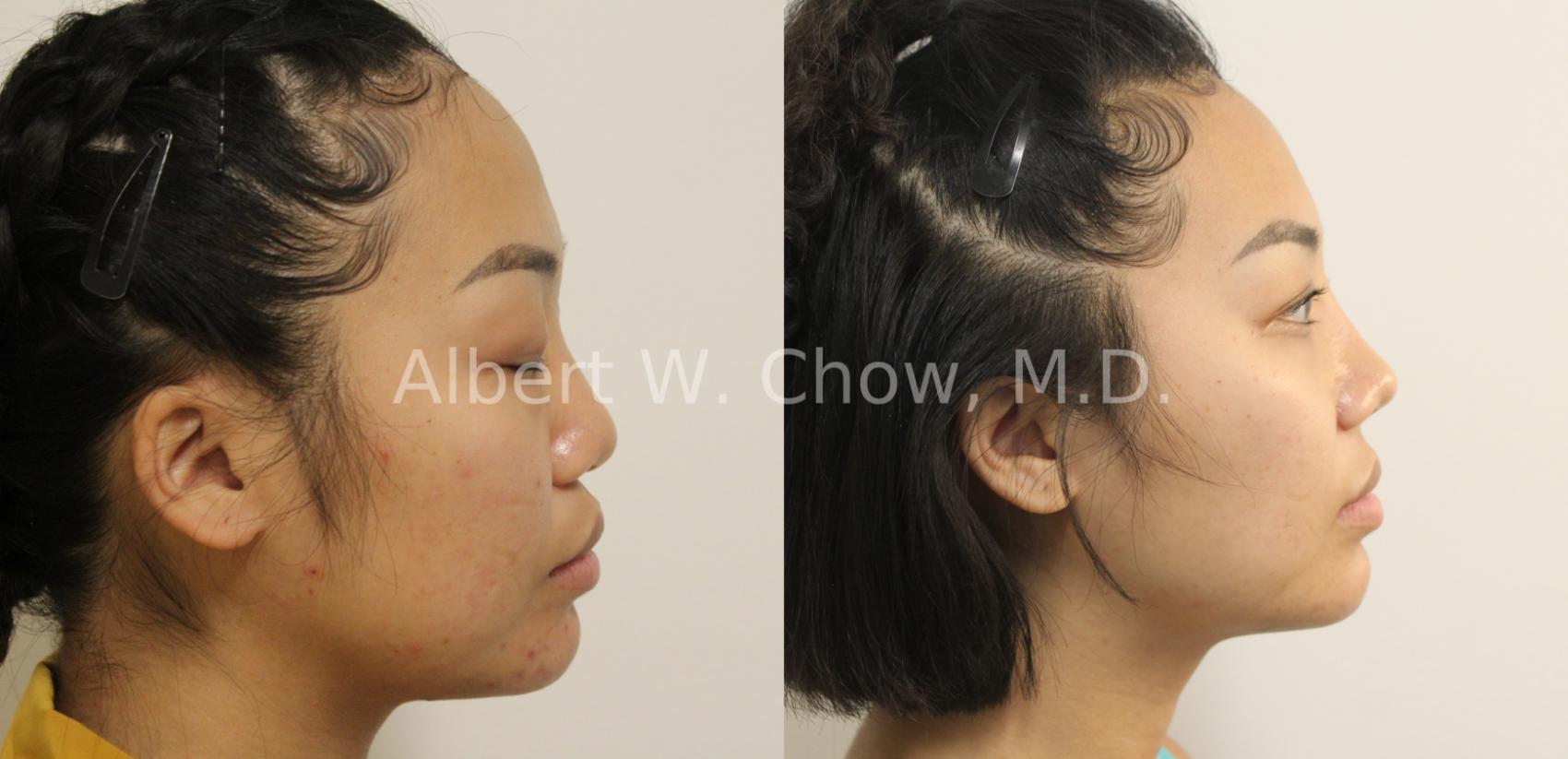 Before & After Asian Rhinoplasty Case 122 View #2 View in San Francisco, CA