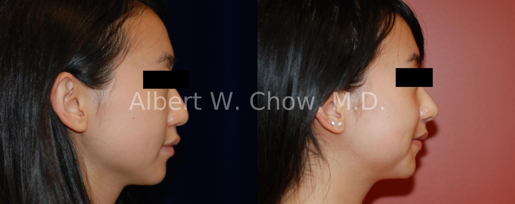 Before & After Asian Rhinoplasty Case 123 View #1 View in San Francisco, CA