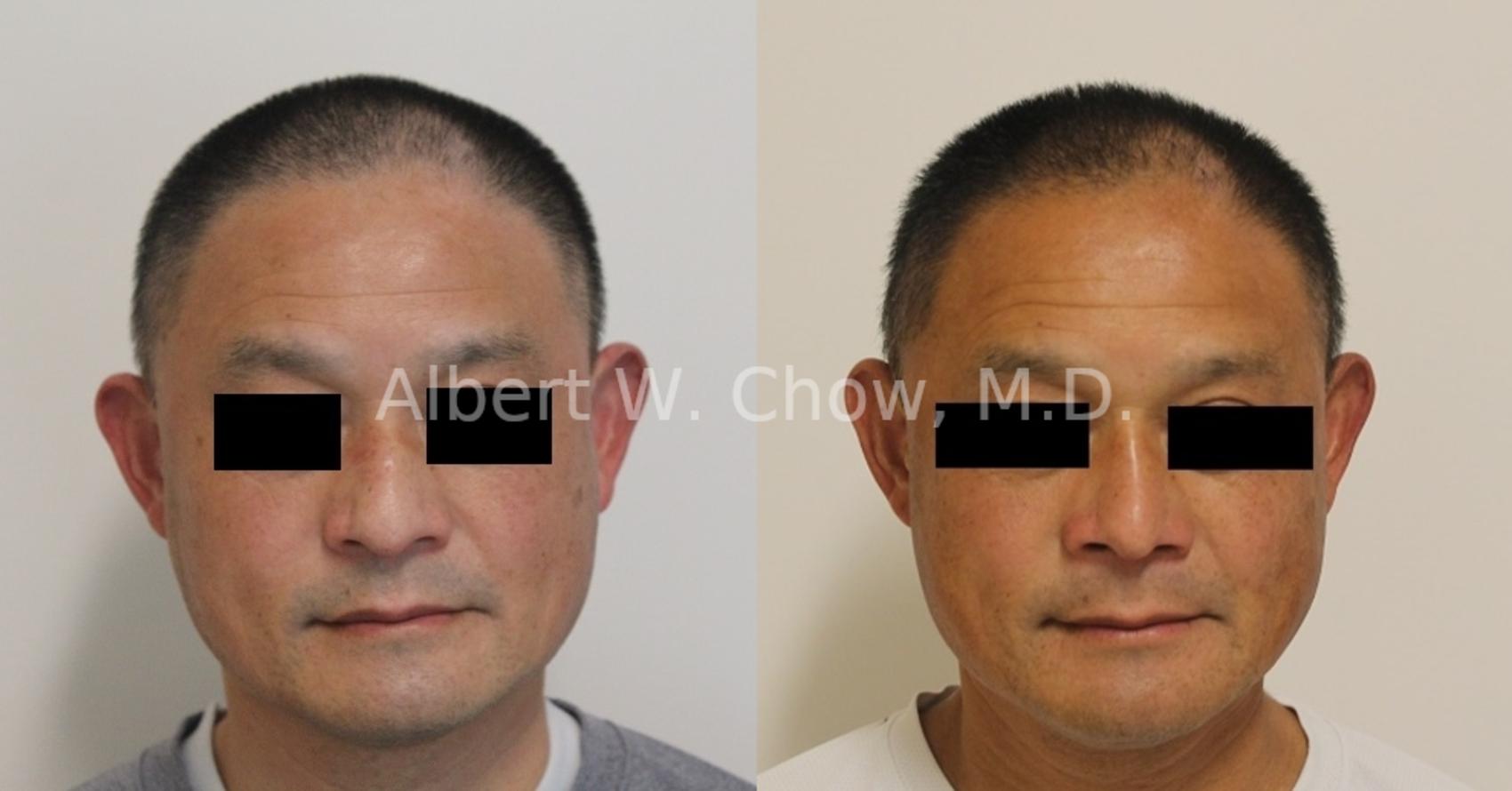 Before & After Asian Rhinoplasty Case 124 Front View in San Francisco, CA