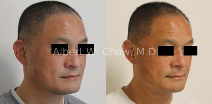 Before & After Asian Rhinoplasty Case 124 Right Oblique View in San Francisco, CA