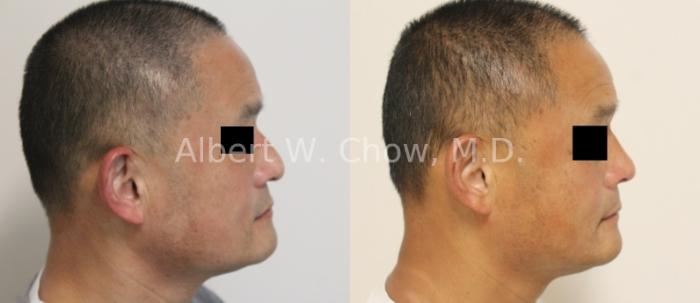 Before & After Asian Rhinoplasty Case 124 Right Side View in San Francisco, CA