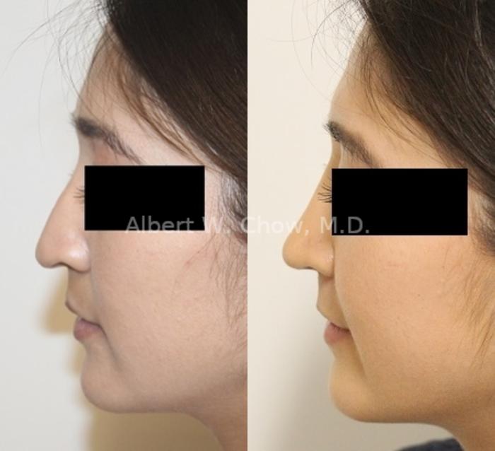 Before & After Asian Rhinoplasty Case 125 Left Side View in San Francisco, CA