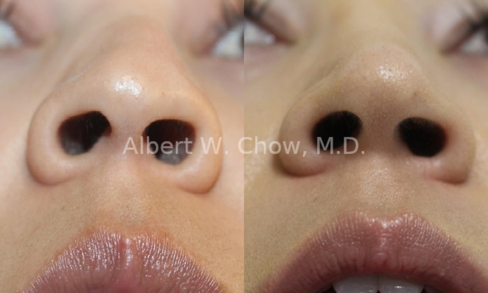 Asian Rhinoplasty Before And After Pictures Case 125 San Francisco