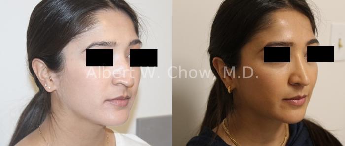 Before & After Asian Rhinoplasty Case 125 Right Oblique View in San Francisco, CA