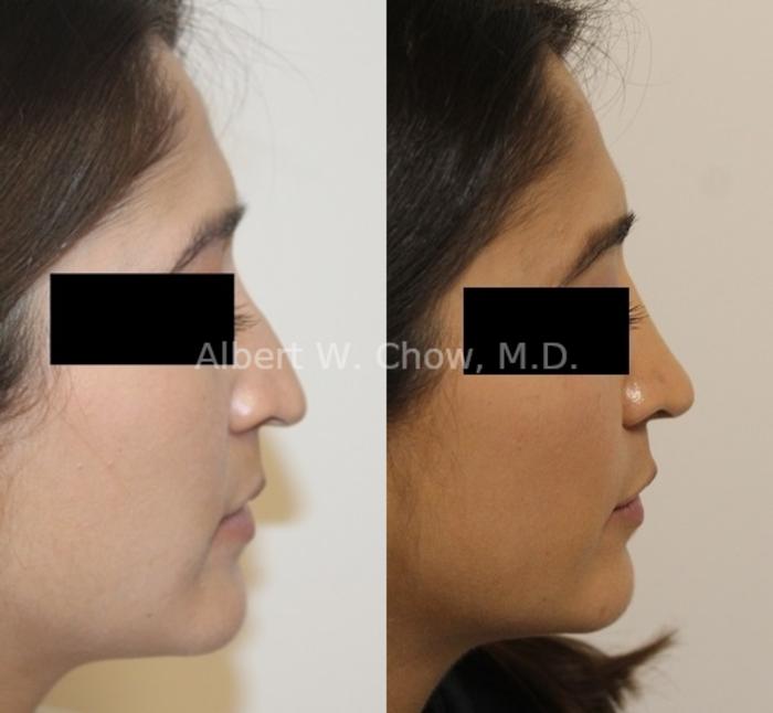 Before & After Rhinoplasty Case 125 Right Side View in San Francisco, CA