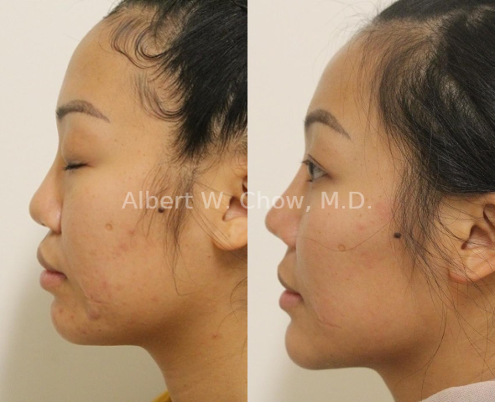 Before & After Rhinoplasty Case 126 Left Side View in San Francisco, CA