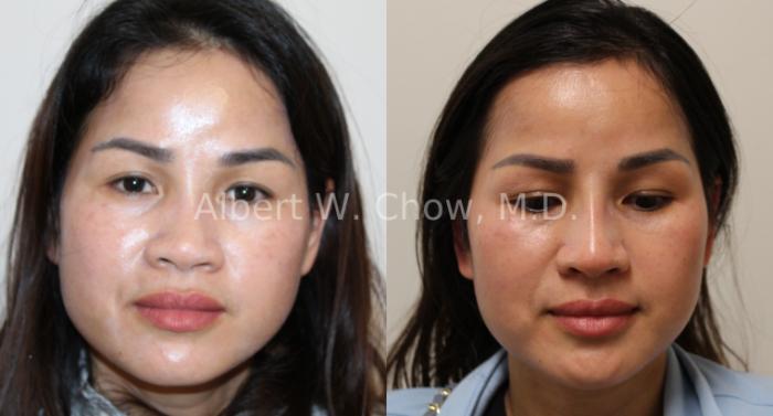 Before & After Asian Rhinoplasty Case 127 Front View in San Francisco, CA