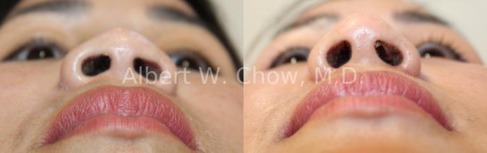 Before & After Asian Rhinoplasty Case 127 Nose from below View in San Francisco, CA