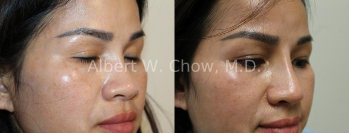 Before & After Asian Rhinoplasty Case 127 Right Oblique View in San Francisco, CA