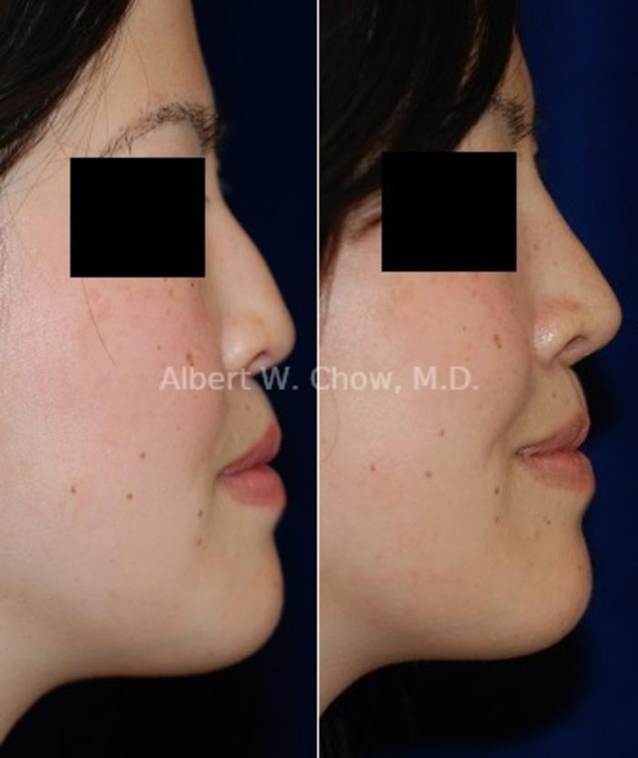 Before & After Rhinoplasty Case 54 View #1 View in San Francisco, CA