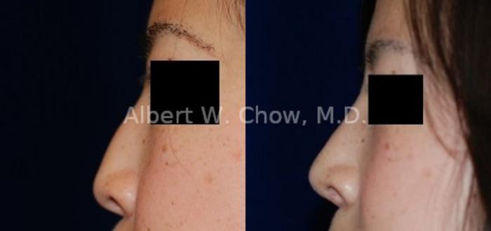 Before & After Asian Rhinoplasty Case 54 View #2 View in San Francisco, CA