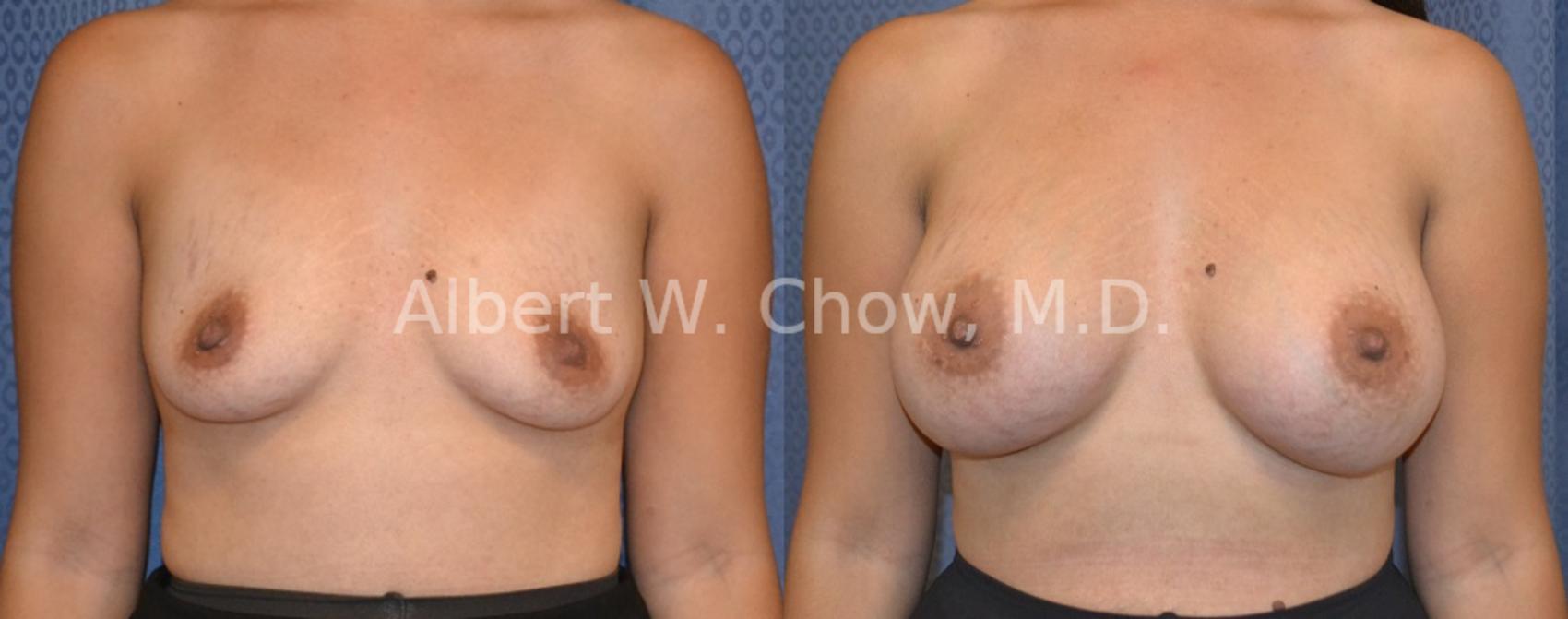 Before & After Breast Augmentation Case 106 View #1 View in San Francisco, CA