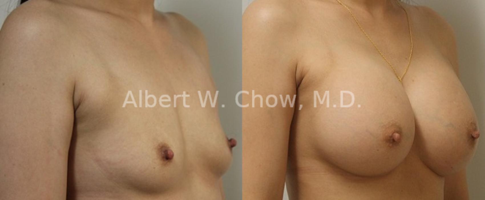 Before & After Breast Augmentation Case 109 View #1 View in San Francisco, CA