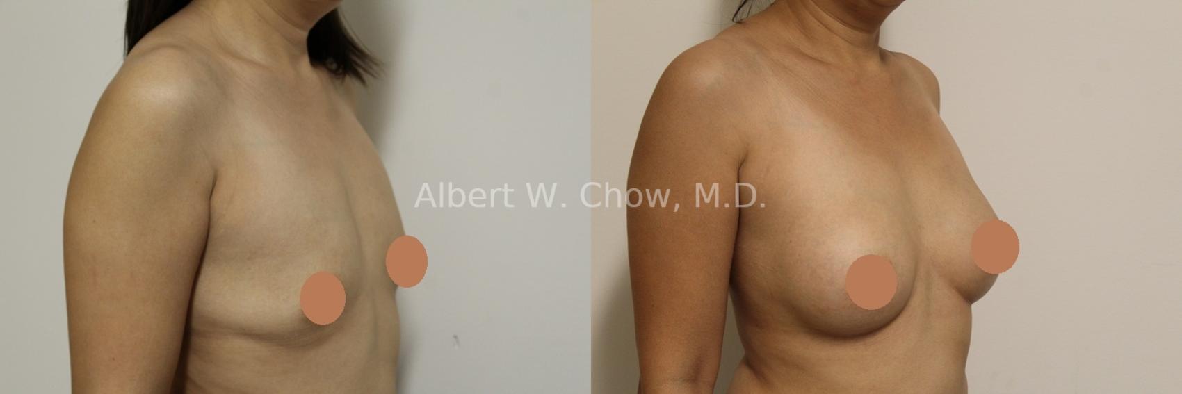 Breast Augmentation 