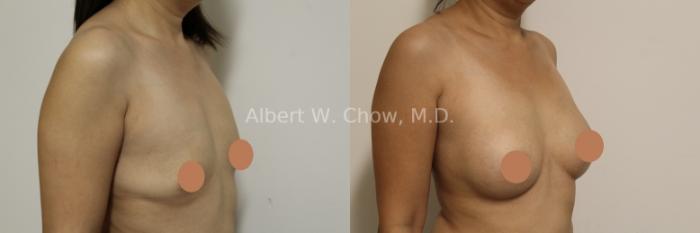 Breast Augmentation 
