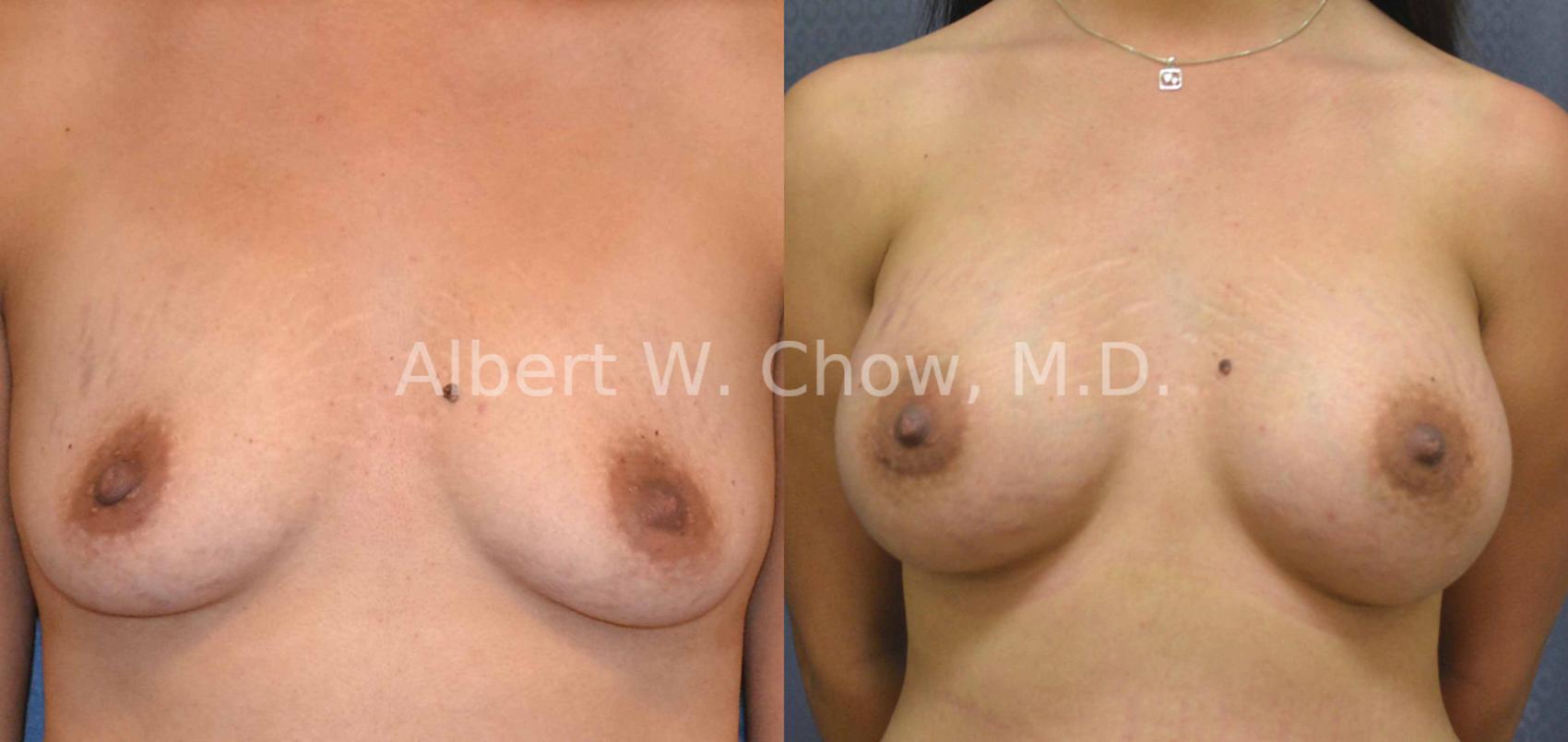 Before & After Breast Augmentation Case 15 View #1 View in San Francisco, CA