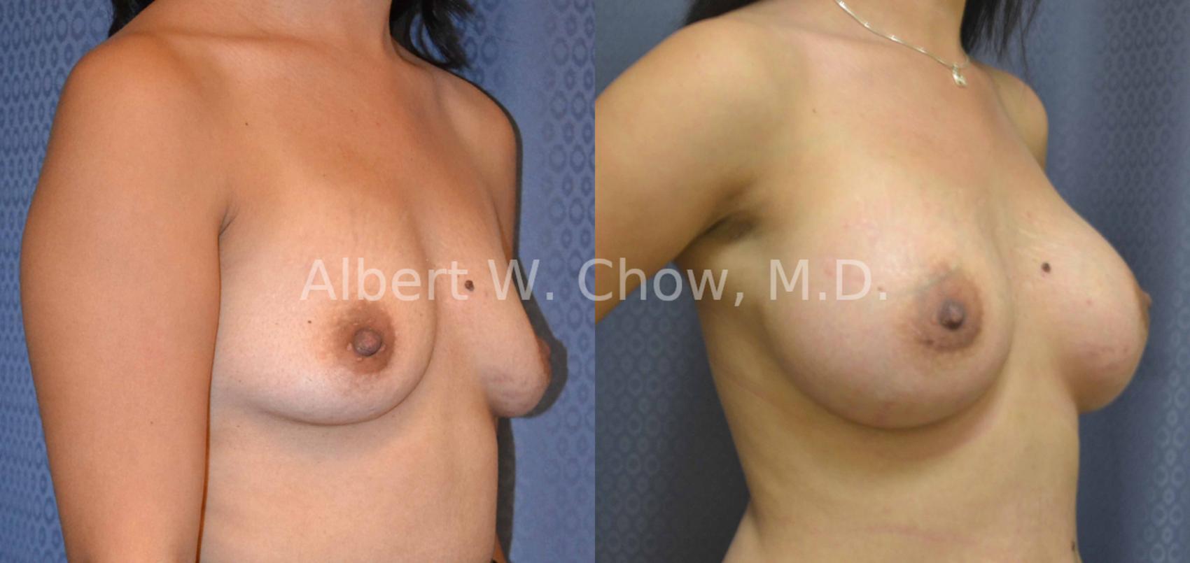 Before & After Breast Augmentation Case 15 View #2 View in San Francisco, CA