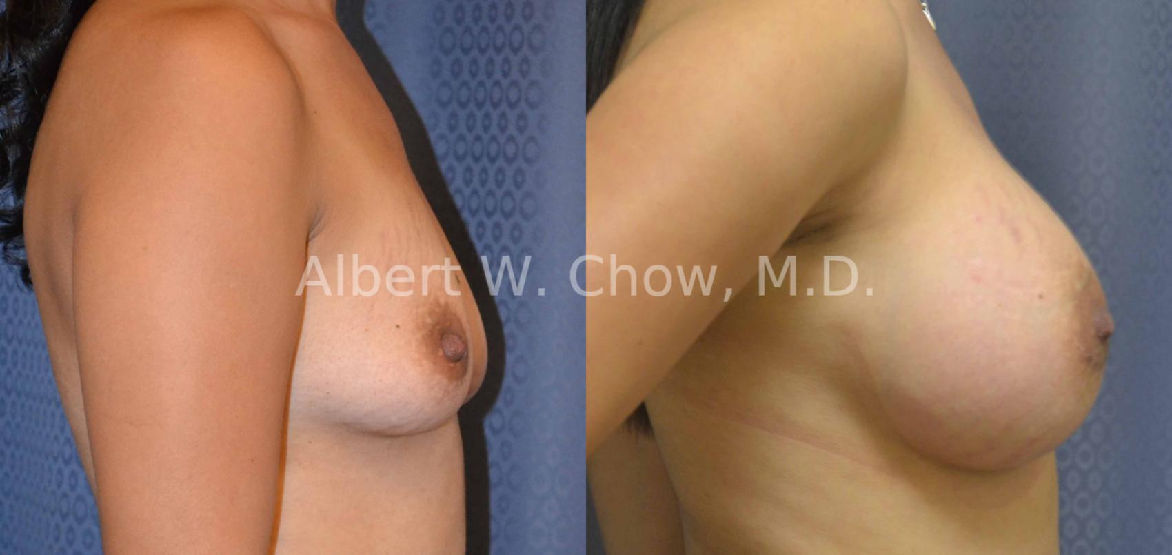 Before & After Breast Augmentation Case 15 View #3 View in San Francisco, CA