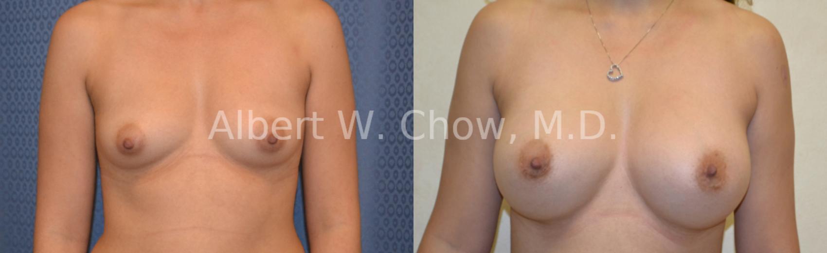 Before & After Breast Augmentation Case 26 View #1 View in San Francisco, CA