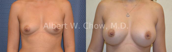 Before & After Breast Augmentation Case 26 View #1 View in San Francisco, CA