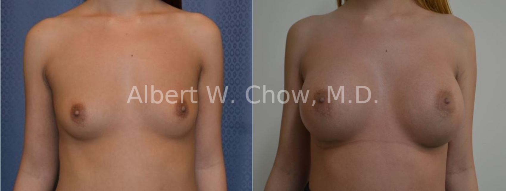 Before & After Breast Augmentation Case 29 View #1 View in San Francisco, CA