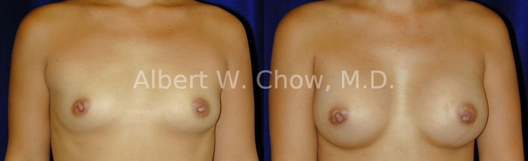 Before & After Breast Augmentation Case 30 View #1 View in San Francisco, CA