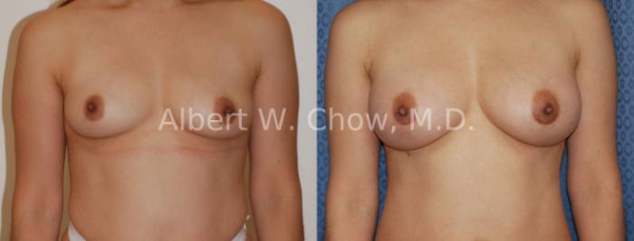 Before & After Breast Augmentation Case 31 View #1 View in San Francisco, CA