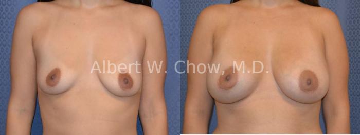 Before & After Breast Augmentation Case 32 View #1 View in San Francisco, CA